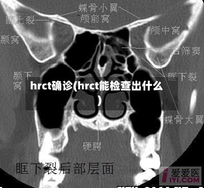 hrct确诊(hrct能检查出什么)-第3张图片