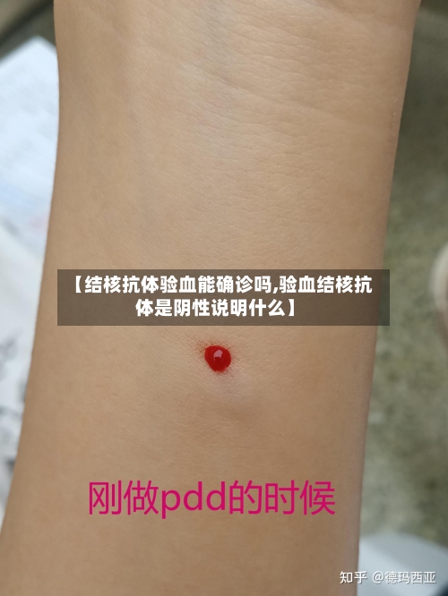 【结核抗体验血能确诊吗,验血结核抗体是阴性说明什么】-第2张图片