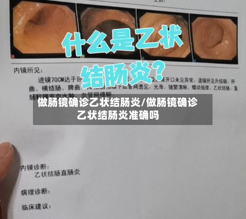 做肠镜确诊乙状结肠炎/做肠镜确诊乙状结肠炎准确吗-第2张图片