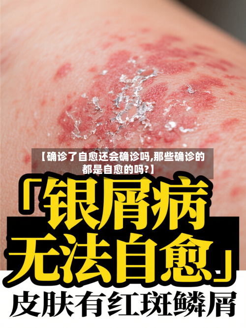 【确诊了自愈还会确诊吗,那些确诊的都是自愈的吗?】