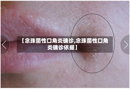 【念珠菌性口角炎确诊,念珠菌性口角炎确诊依据】-第2张图片
