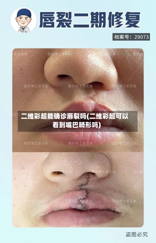 二维彩超能确诊唇裂吗(二维彩超可以看到嘴巴畸形吗)-第3张图片