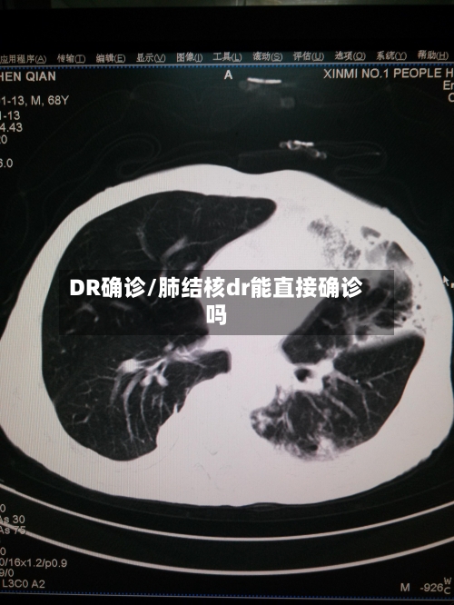 DR确诊/肺结核dr能直接确诊吗-第2张图片