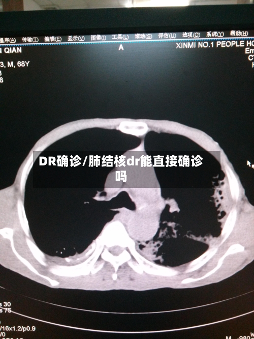 DR确诊/肺结核dr能直接确诊吗