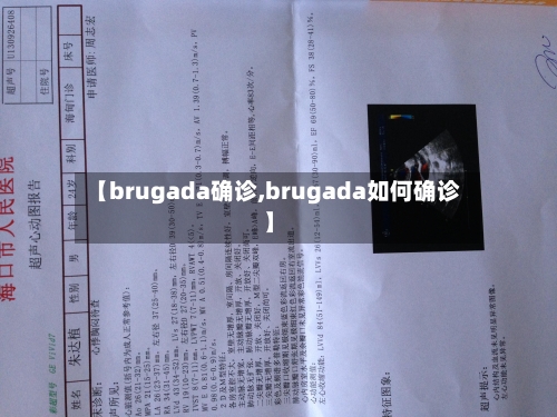 【brugada确诊,brugada如何确诊】-第2张图片