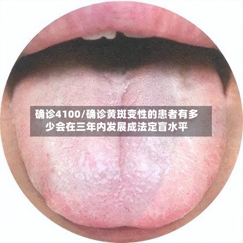 确诊4100/确诊黄斑变性的患者有多少会在三年内发展成法定盲水平-第2张图片
