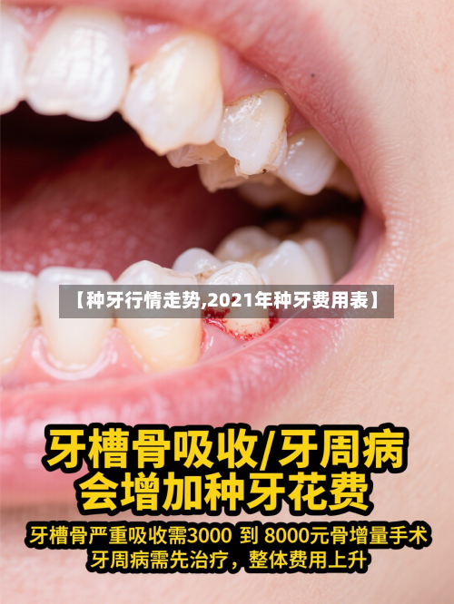 【种牙行情走势,2021年种牙费用表】