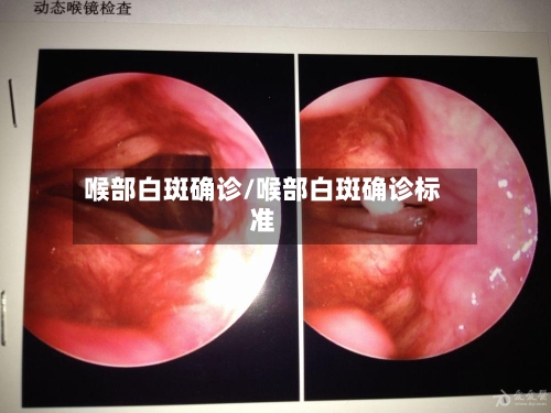 喉部白斑确诊/喉部白斑确诊标准-第2张图片