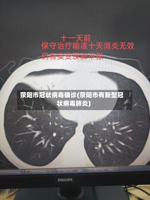 荥阳市冠状病毒确诊(荥阳市有新型冠状病毒肺炎)