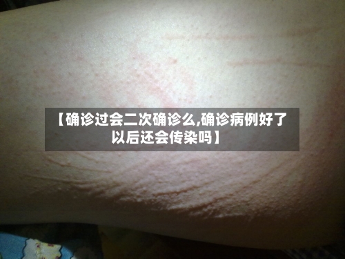 【确诊过会二次确诊么,确诊病例好了以后还会传染吗】
