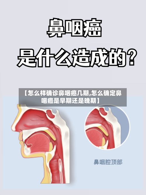 【怎么样确诊鼻咽癌几期,怎么确定鼻咽癌是早期还是晚期】-第2张图片
