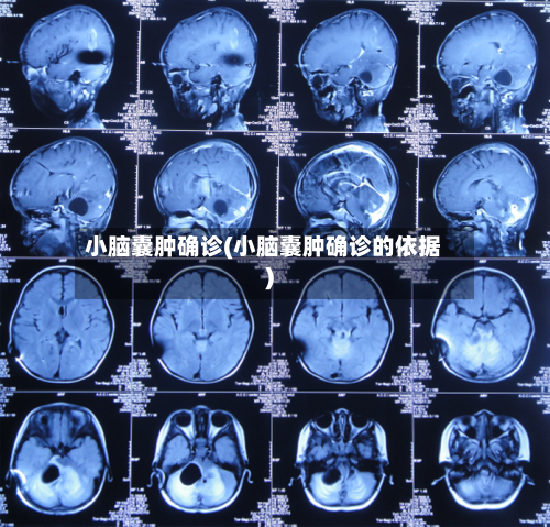 小脑囊肿确诊(小脑囊肿确诊的依据)-第3张图片