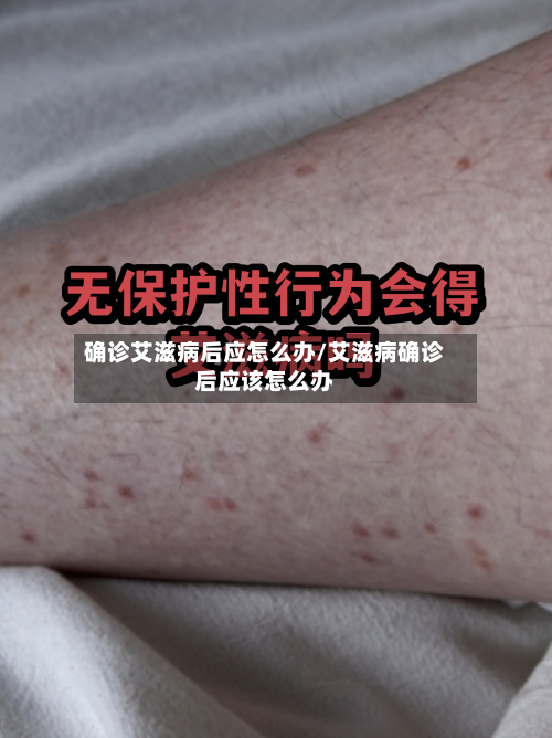 确诊艾滋病后应怎么办/艾滋病确诊后应该怎么办