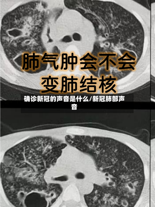 确诊新冠的声音是什么/新冠肺部声音-第2张图片