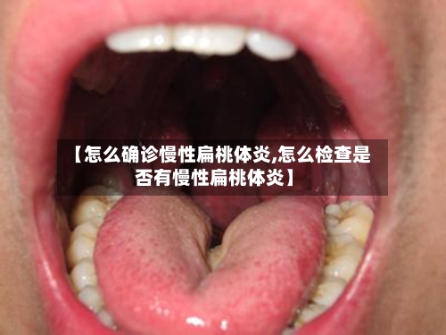 【怎么确诊慢性扁桃体炎,怎么检查是否有慢性扁桃体炎】-第3张图片