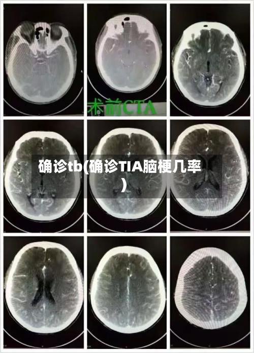 确诊tb(确诊TIA脑梗几率)